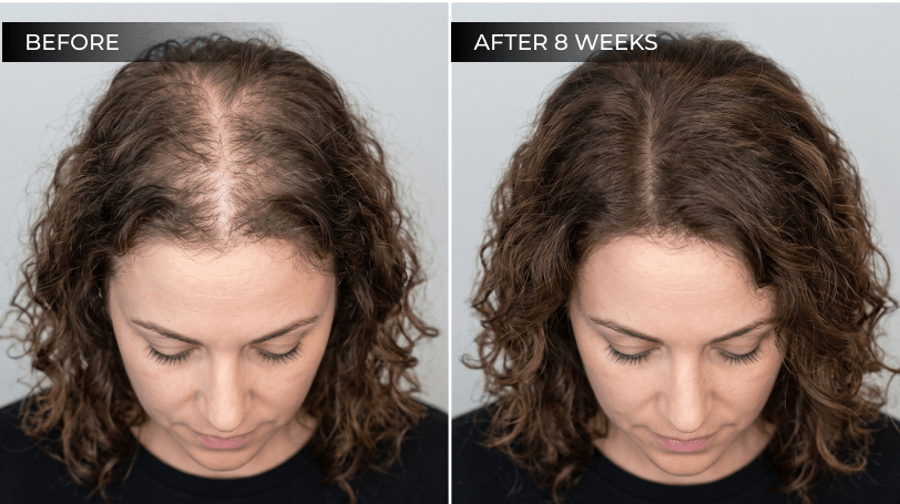 Before-and-after illustration of a fuller-looking hairline after an 8-week daily hair care routine.